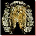 AL 666-1: 2.3 milyon yıllık Homo sapiens (insan) çenesiAL 666-1-in yan tərəfdən görünüşüAL 666-1 : 2,3 milyon illik Homo